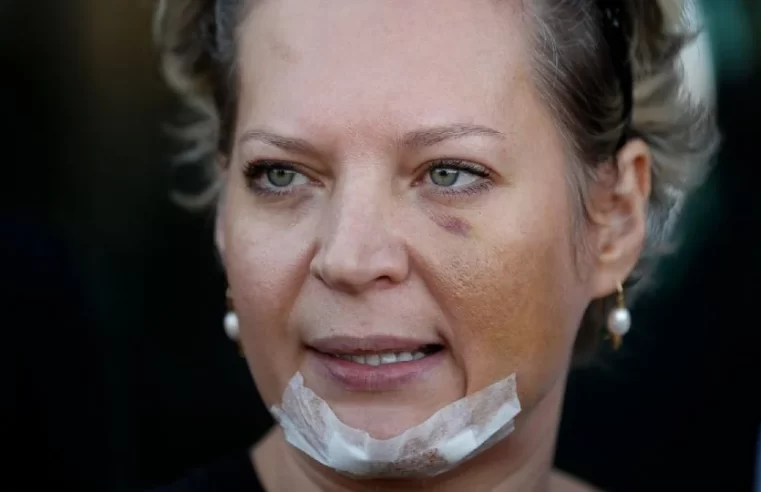 Joice Hasselmann denuncia: “Fui espancada por kids pretos a mando da família Bolsonaro” — “Queriam me deixar tetraplégica”