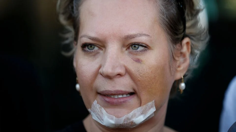 Joice Hasselmann denuncia: “Fui espancada por kids pretos a mando da família Bolsonaro” — “Queriam me deixar tetraplégica”